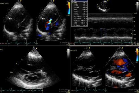 lv insult with dilation asos|lv dilatation with normal ef.